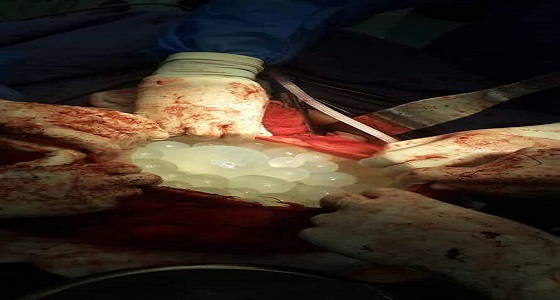 إجراء عملية إزالة أكياس كلبية في مستشفى الامير راشد العسكري