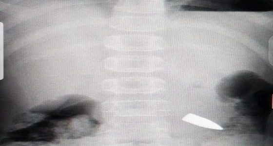 إنقاذ طفل بعد استخراج عيار ناري ” طائش ” من ظهره بالرياض