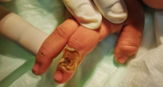 صبيا: عامود إنارة مكشوف يصعق طفل ويسبب له حروق بالغة