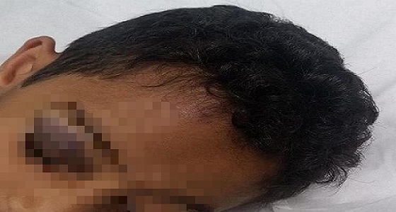 كسر في جمجمة طالب داخل مدرسته..والسبب غير معروف