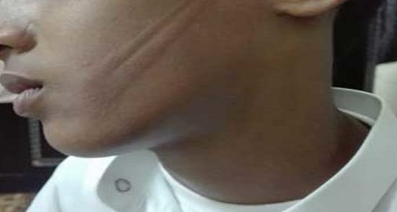 طالب يتعرض للاعتداء بـ ” سلك ” على وجهه من قبل معلمه