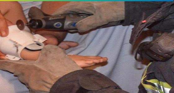 بالصور.. ” مدني جدة ” ينقذ قدم طفل من قطعة بلاستيكية