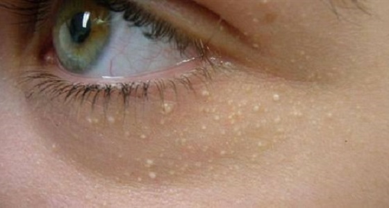 6 أسباب لظهور الحبوب البيضاء وطرق علاجها