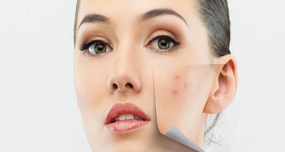 تخلصي من حب الشباب بهذه الخطوات البسيطة