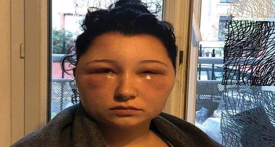 بالفيديو والصور.. تعرض فتاة لتشوهات إثر استخدامها صبغة شعر تنتجها علامة تجارية شهيرة