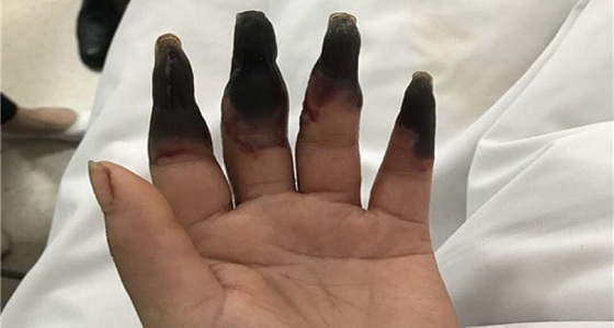 بالصور.. ماذا فعلت هذه المرأة كي تتحوّل أصابعها إلى اللون الأسود؟
