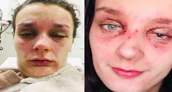 بسبب بيضة..حادث مروع لفتاة كاد أن يفقدها بصرها