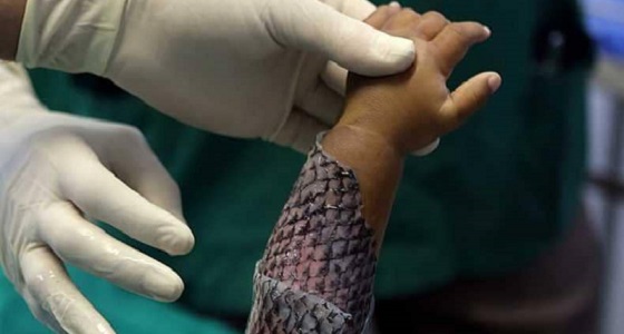 مفاجأة.. جلد السمك علاج سحري للحروق