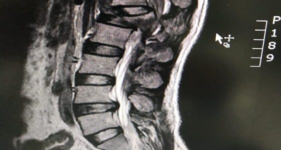 جراحة عاجلة لإعادة الحركة لمصاب في حادث مروري