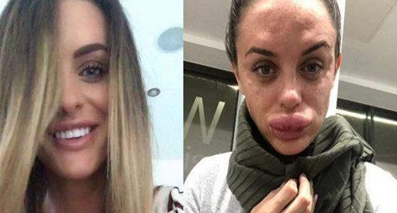 فتاة تكاد تفقد شفاهها للأبد بسبب ” البوتوكس “