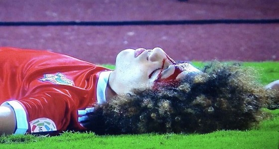 جراحة ناجحة للاعب الوحدة لتثبيت عظام الوجه