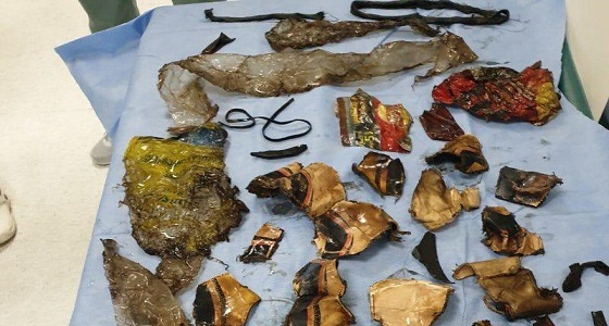 جراحون ينقذون حياة شاب ابتلع كرة قدم وبالونات في جدة