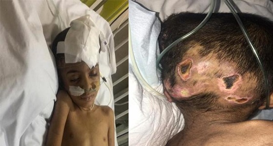 بالصور.. آثار تعذيب على جسد طفل بخميس مشيط