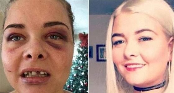 فتاة تتعرض لاعتداء عنيف من حبيبها السابق بسبب صورتها علي فيسبوك