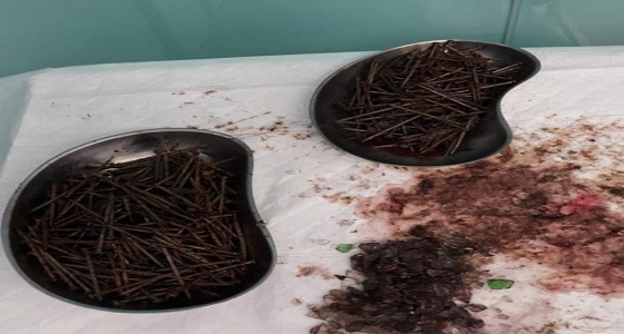 استخراج مسامير وزجاج من معدة مريض بجدة