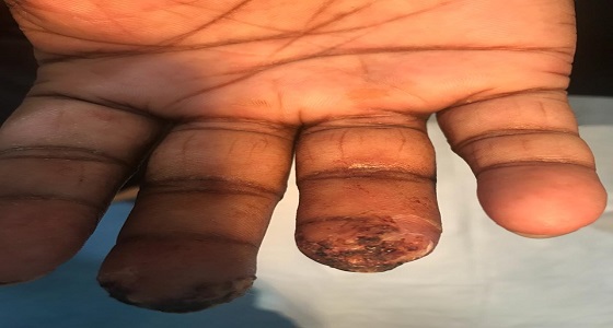 بالصور: فريق طبي من مستشفى الدلم ينقذ يد مقيم تهتكت اصابعه.