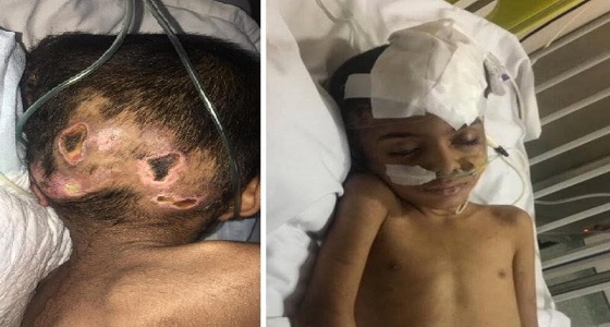 نقل طفل خميس مشيط المعنف إلى مستشفى الحرس الوطني بالرياض