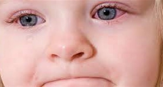 بالفيديو.. أعراض تؤكد إصابة طفلك بحساسية العين