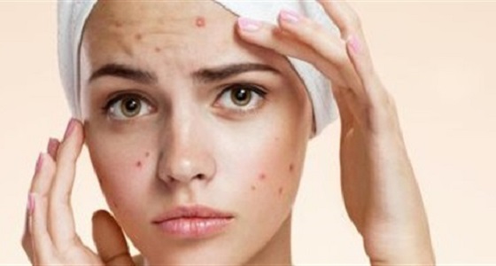 6 نصائح للتعامل مع حب الشباب