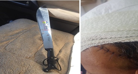 مريض نفسي يشج رأس مواطن بساطور بتبوك