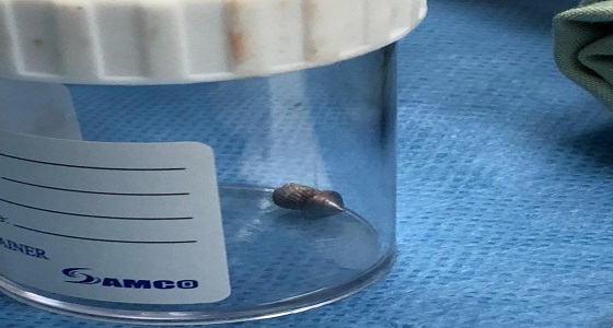 بالصور.. إصابة شاب برصاصة في البطين الأيمن بجدة