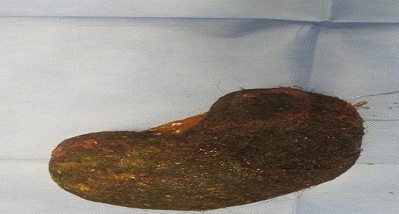 إستخراج كتلة شعر ضخمة من معدة فتاة بمستشفى القريات العام