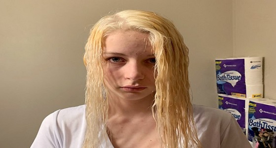 بالصور.. تآكل شعر فتاة بطريقة مروعة بسبب الصبغة المنزلية