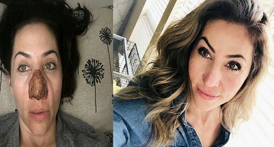عملية تجميل تتسبب في تشويه وجه فتاة حسناء 