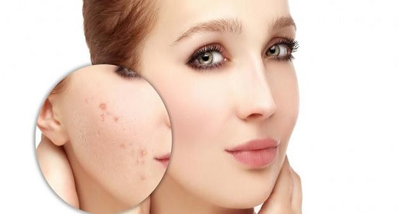 استخدمي ماسك جوز الطيب للتخلص من حبوب البشرة نهائيا