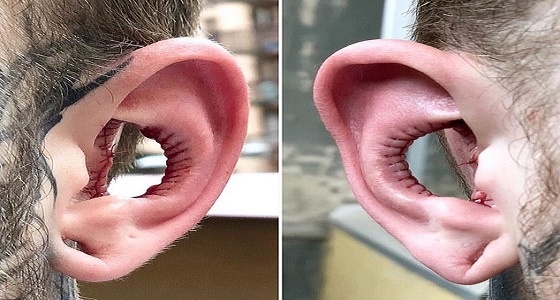 بالصورة.. موضة جديدة تجتاح الإنترنت.. ” استئصال جزء كبير من الأذن “