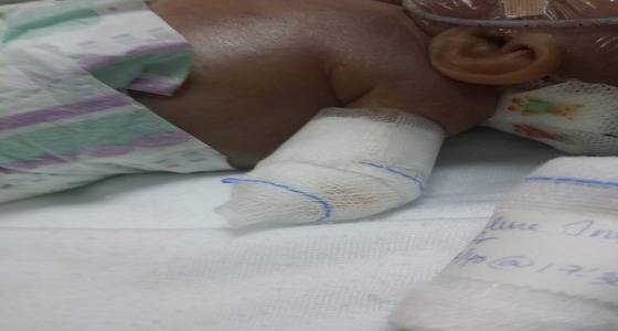 طفل حديث الولادة يفقد ذراعه بتبوك.. والصحة: حدث بتر ذاتي