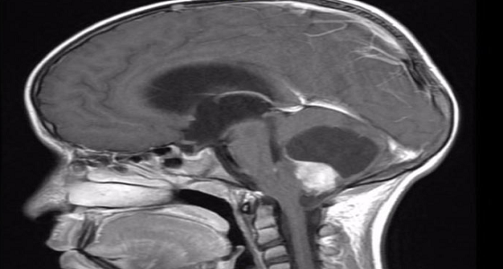 طفل يعود إلى مدرسته بعد استئصال ورم من مخه بشرق جدة