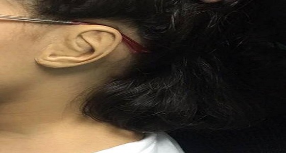 40 زراعة للأذن التجميلية بمدينة الملك سعود الطبية