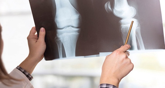 ” فقدان طول الجسم ” .. اعراض هشاشة العظام عند النساء