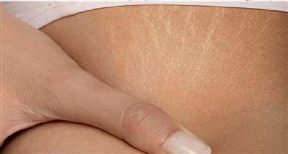 دراسة: علامات التمدد وراثية ولا علاقة لها بالحمل