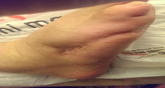 مستشفى المملكة ينجح في إنقاذ قدم مريض من البتر