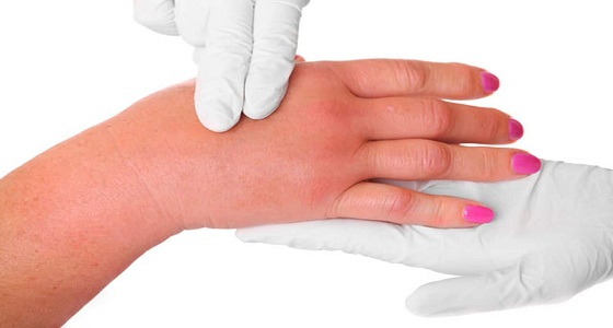 ” القهوة والأملاح ” .. أسباب احتباس السوائل عند المرأة الحامل