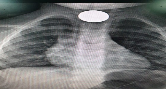 بالصور.. فريق طبي يستخرج عملة معدنية من مرئ طفل بالقنفذة