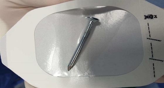 فريق طبي ينقذ عين امرأة استقر في عينها ” مسمار ” بسكاكا 