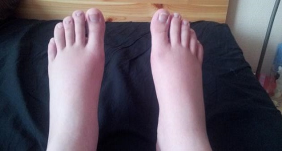 نصائح هامة للتخلص من احتباس السوائل في جسمك