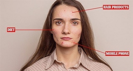 جراح تجميل يحذر من الاستخدام المفرط للهواتف الذكية: تسبب حب الشباب والبقع