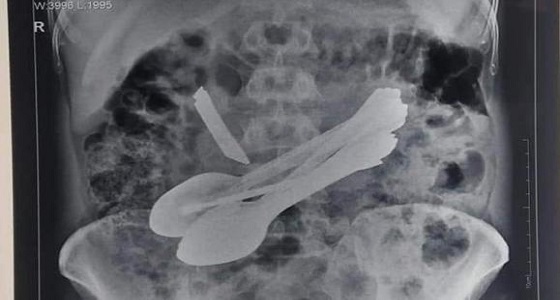 أطباء يستخرجون ملاعق وسكين و ” أشياء أخرى ” من معدة رجل