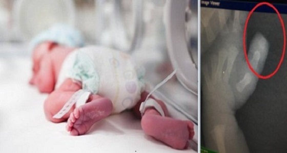 العثور على الجزء المبتور بالقمامة..أخر المستجدات بواقعة بتر إصبع رضيعة أحد رفيدة