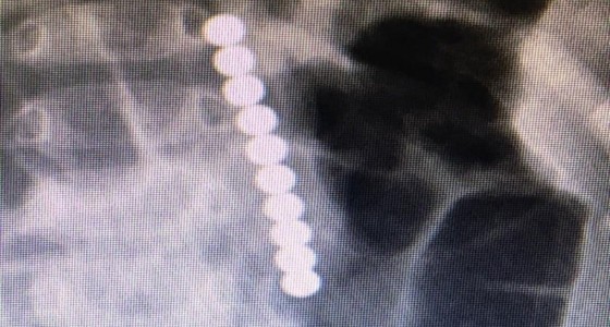 استخراج سبحة من بطن طفل بالأحساء