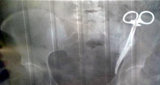 امرأة تكتشف مقصًا داخل بطنها بعد 23 سنة من إجراء عملية