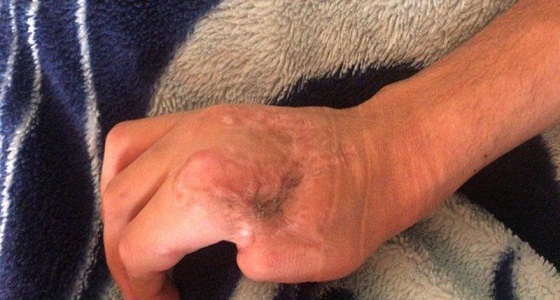 والد الطالب عمر العنزي الذي بتر إبهامه في تقنية تبوك يكشف تفاصيل جديدة