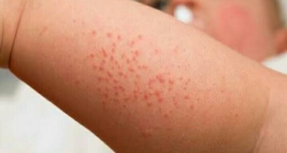 نصائح تساعدك على معالجة ” حمو النيل ” عند الأطفال