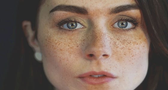 مكونات طبيعية لعلاج النمش