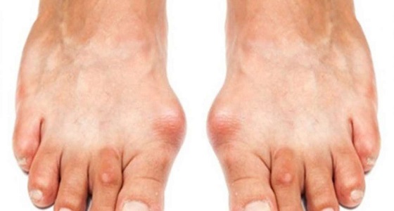طريقة جديدة لعلاج انتفاخ القدمين في نصف ساعة