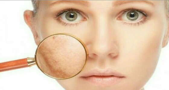 أسباب ظهور ” الكلف ” عند السيدات وطرق علاجه